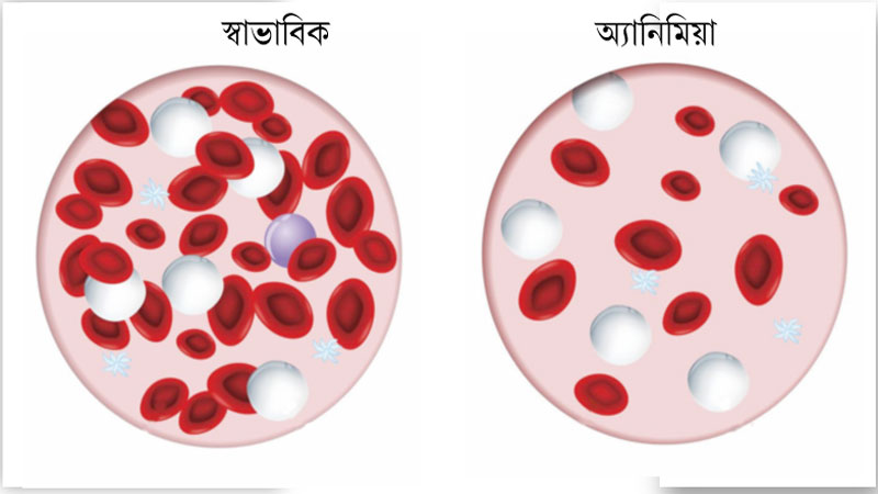 রক্তশূন্যতা কেন হয়? রক্তশূন্যতা কেন হয়?