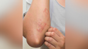বর্ষায় ত্বকের সংক্রমণ এড়াতে কী করবেন