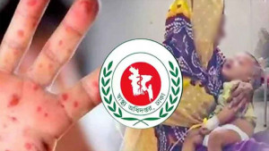 হাম ও উপসর্গে ৬৮ দিনে ৪৯৯ শিশুর মৃত্যু