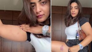 শরীরে আঘাতের দাগ দেখিয়ে যা বললেন অভিনেত্রী
