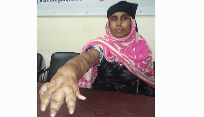 বিরল রোগে আক্রান্ত তাসলিমার দুঃসহ জীবন