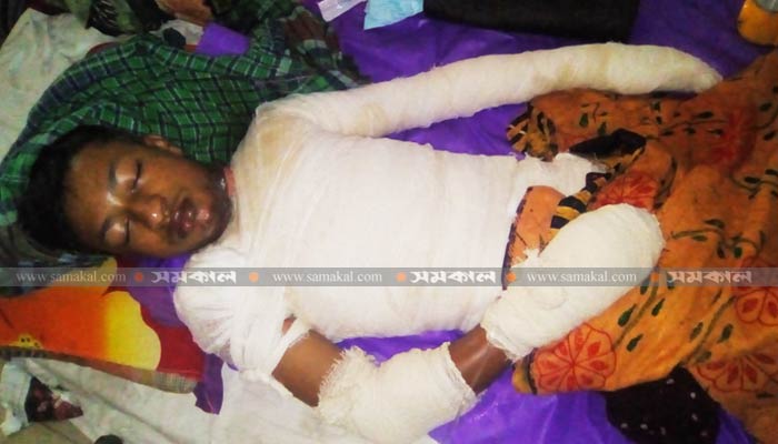 বরিশালে কেরোসিন ঢেলে স্কুলছাত্রকে পুড়িয়ে হত্যাচেষ্টা