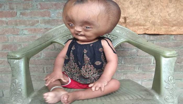 ছোট্ট শরীরে বড় 'বোঝা' বয়ে বেড়াচ্ছে খাদিজা