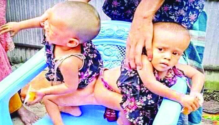 জোড়া লাগা শিশু লাবিবা-লামিসার কী হবে
