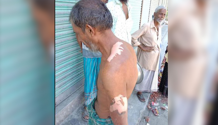 পাওনা টাকা চাওয়ায় দোকানিকে গরম পানিতে ঝলসে দেওয়ার অভিযোগ