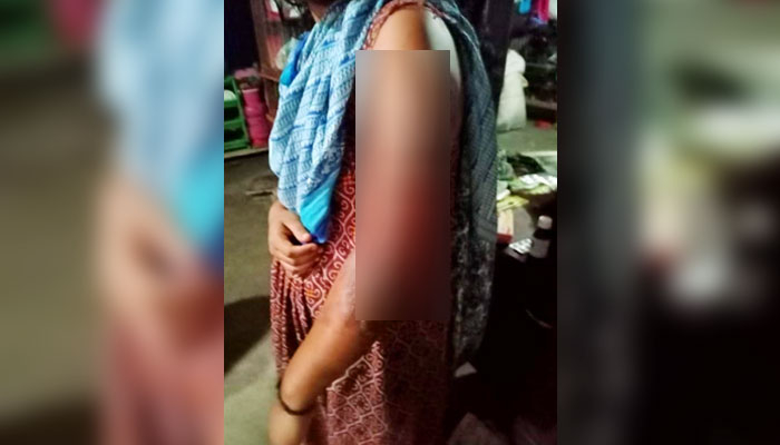 গরম তেলে ঝলসে দিল স্ত্রীর শরীর
