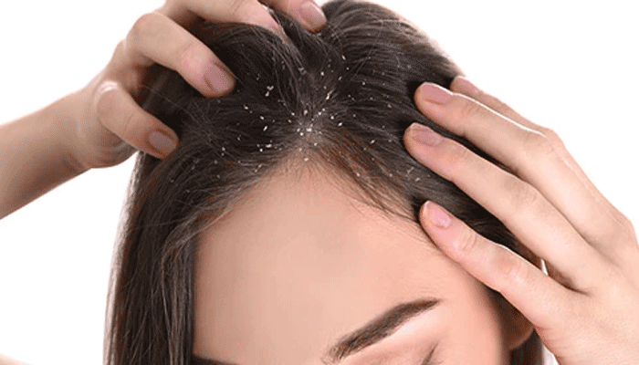 শীতে খুশকি দূর করার ঘরোয়া উপায়