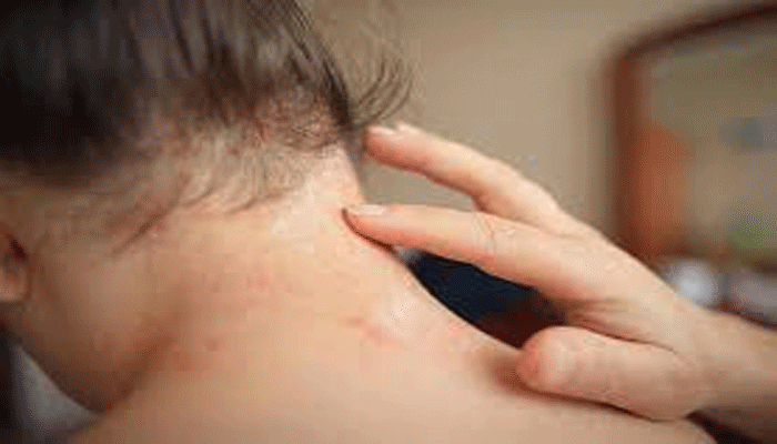 গরমে র‍্যাশ-চুলকানি এড়াতে কী করবেন